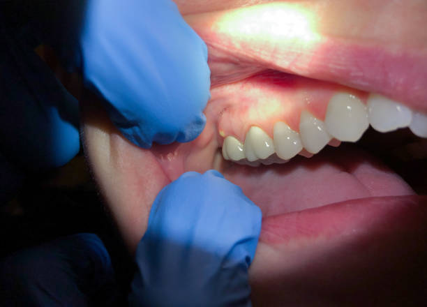 Emergency Dental Filling Replacement in AL